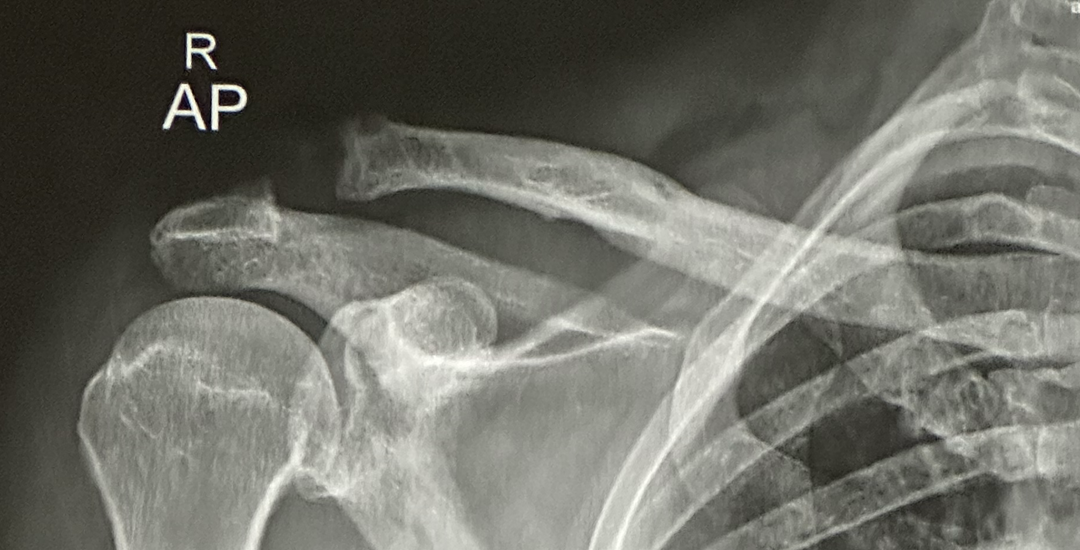 I dislocated my clavicle, tearing all three tendons.